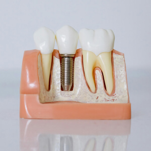 Implantáty